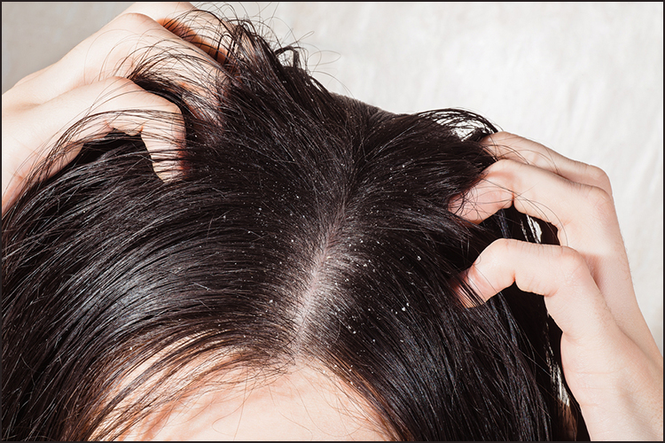 脂漏性脱毛症の原因と特徴