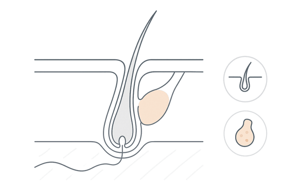 毛包断面と皮脂腺を強調した図解｜5αリダクターゼ1型の発現イメージ