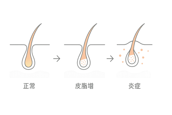 皮脂分泌亢進と毛穴詰まりのプロセス（正常→皮脂増→炎症の3ステップ）