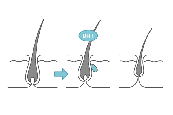 DHTが毛根に与える影響と毛包の萎縮プロセスを示す図