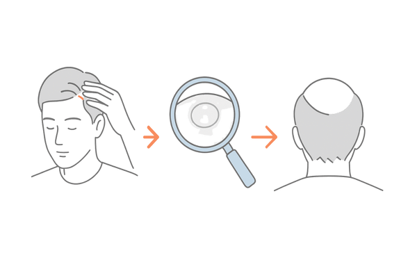 円形脱毛症の初期サイン｜小さな円形の脱毛斑・境界の確認・頭皮のツヤ（男性）