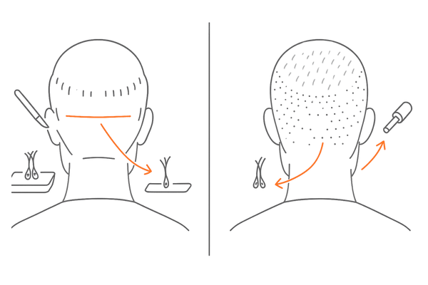 自毛植毛のFUT法とFUE法の違いを比較する図（採取方法・傷跡・移植イメージ）