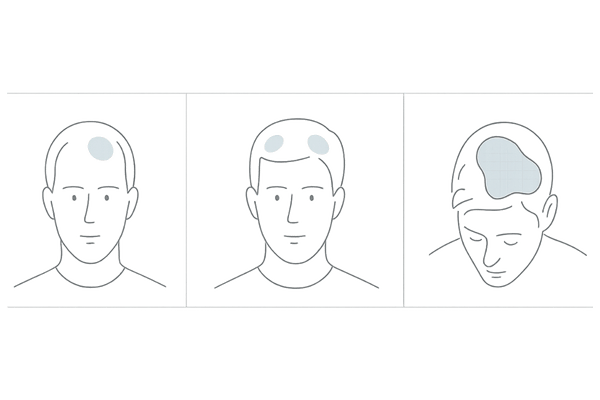 円形脱毛症の代表的な脱毛パターン（単発・多発・くっつき型）の比較イメージ