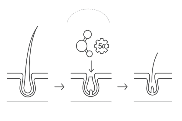 頭頂部の薄毛が進む仕組み(DHTと毛周期短縮の流れ)図解|つむじ周辺で起こるミニチュア化