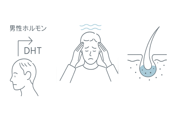 つむじはげが進行する3つの主な原因(ホルモン・ストレス・頭皮環境)の図解