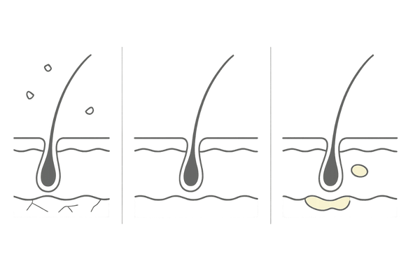 乾燥フケと脂性フケの違いを示す頭皮イメージ