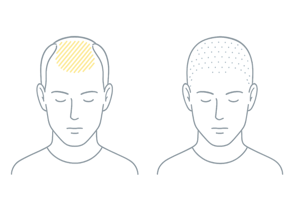 AGAとの違い比較｜部分型（M字・頭頂）とびまん型のパターン（2パネル）