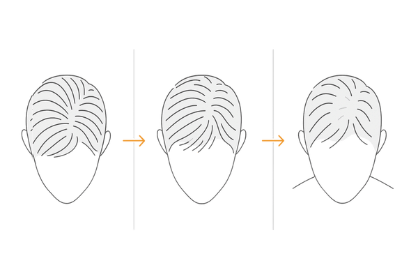 びまん性脱毛症の症状|全体のボリューム低下の進行イメージ