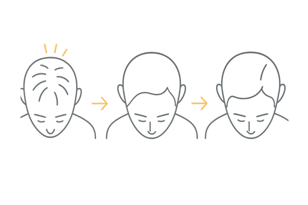 デュタステリドの効果が現れるまでの期間イメージ｜初期脱毛～半年以降の推移