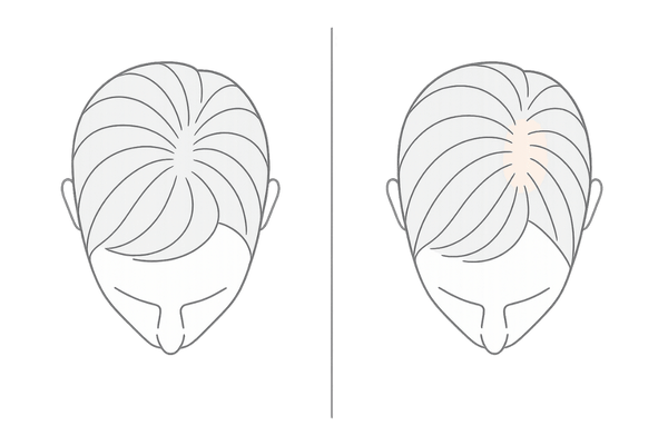 つむじはげ初期症状の見分け方|正常なつむじとの比較イラスト(男性・頭頂部・AGA)