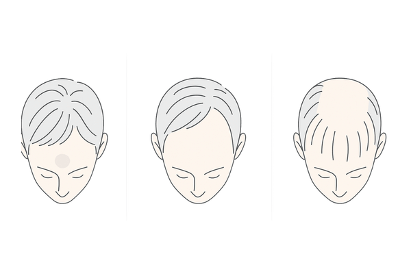 つむじはげの進行度|初期・中期・進行期の頭頂部の見た目比較イラスト