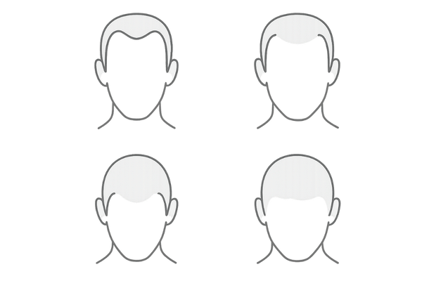 AGAの進行パターン4タイプ｜M字・U字・O字・全体型のシンプル図解