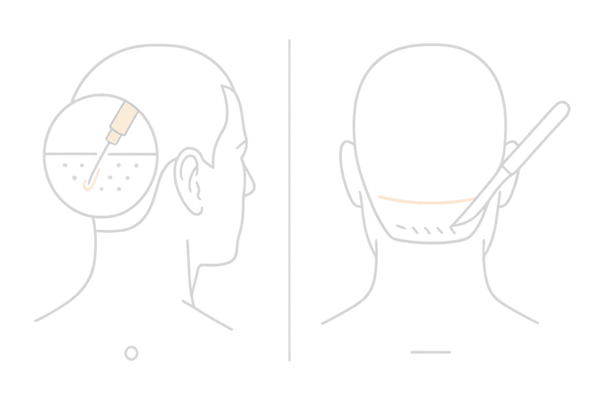 FUEとFUTの違い（採取方法・傷跡）の比較イメージ