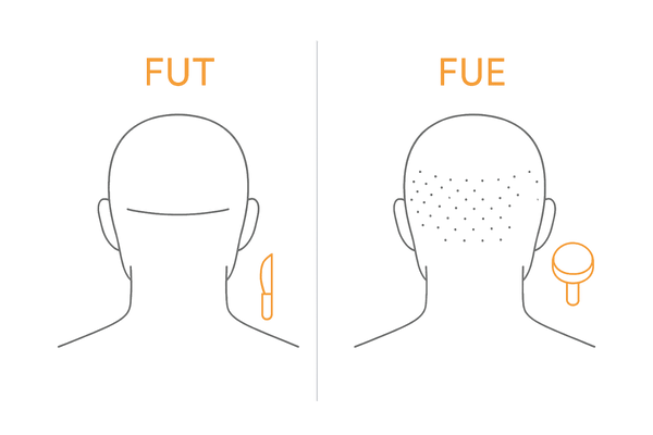 FUT法とFUE法の違い:傷跡と採取方法の2パネル比較(自毛植毛)