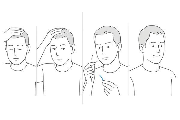 自毛植毛後の経過スケジュール（術直後～半年以降まで）の流れ