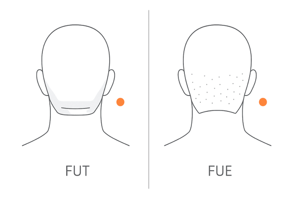 FUTとFUEの傷跡の違い図解|線状痕と点状痕の後頭部比較イラスト