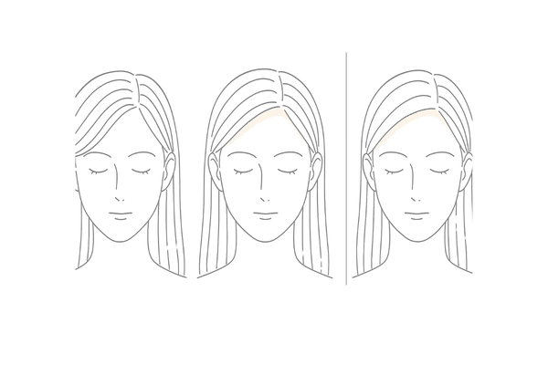 女性の生え際M字進行パターン｜3段階比較イラスト