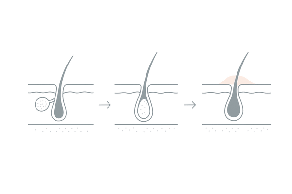 毛穴詰まりから炎症までの頭皮断面3ステップ（皮脂・角栓・炎症）
