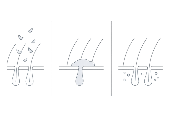 乾燥性フケ・脂性フケ・白い粉の違いを比較した図