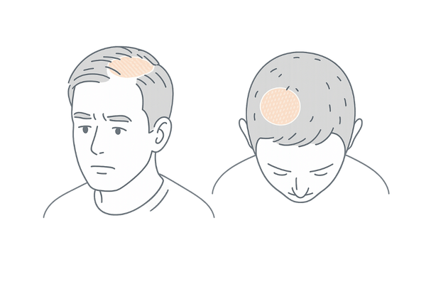 AGAと円形脱毛症の見た目の違いを比較したイメージイラスト