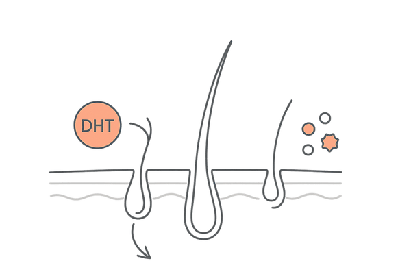 AGAと円形脱毛症の原因とメカニズムを示すヘアサイクル図解