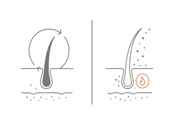 AGAとフケの関連性|頭皮環境の乱れとヘアサイクル短縮の図解
