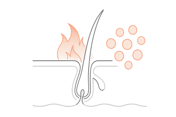円形脱毛症の原因（自己免疫による毛根攻撃）の模式図