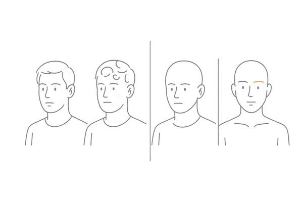 円形脱毛症のタイプ別（単発型・多発型・全頭型・汎発型）比較図