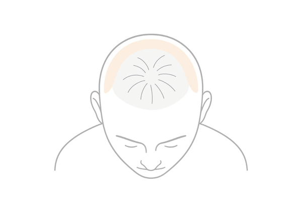 つむじ薄毛の特徴と進行イメージ｜渦状の毛流れと地肌露出