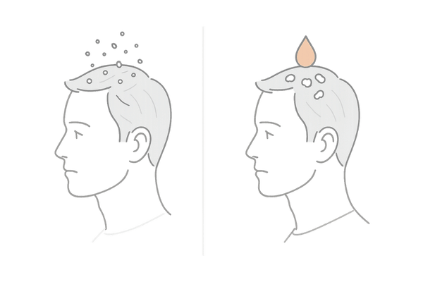 乾性フケと脂性フケの違いがわかる比較イラスト