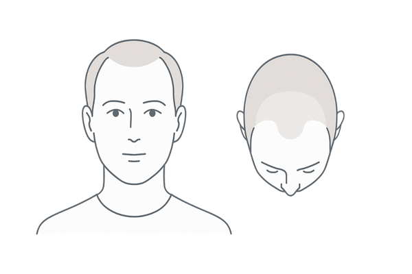 びまん性脱毛症の全体的な薄毛パターンを示す頭部シルエット図