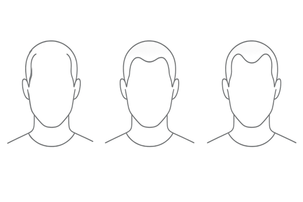 M字型薄毛の進行パターンと生え際後退の特徴