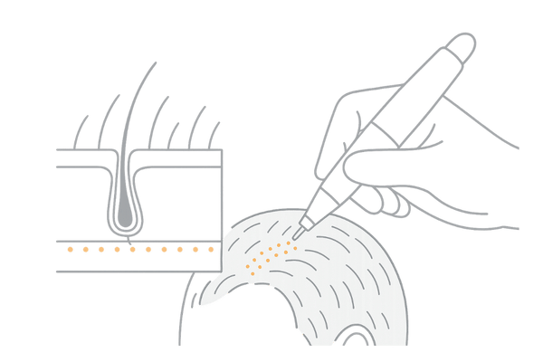 頭皮タトゥー（SMP）の仕組みと施術イメージ図