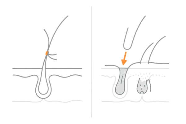 増毛と自毛植毛の方法と仕上がりのイメージ図