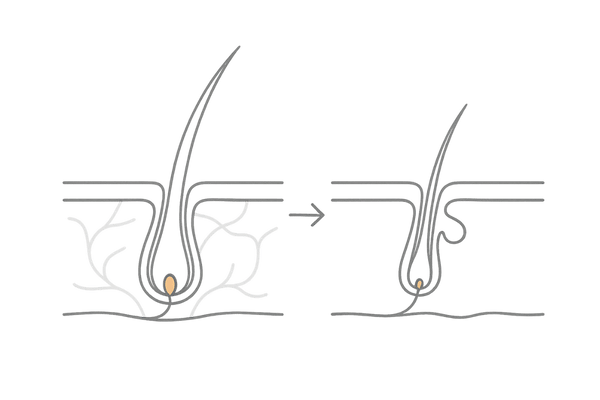 DHTによる毛包ミニチュア化と薄毛進行メカニズム図