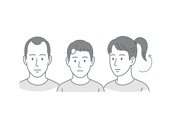主な脱毛症の種類と特徴が一目でわかる男性頭部シルエットイラスト