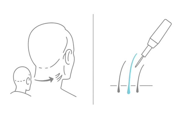 自毛植毛と人工毛植毛の違いを示す比較イメージ