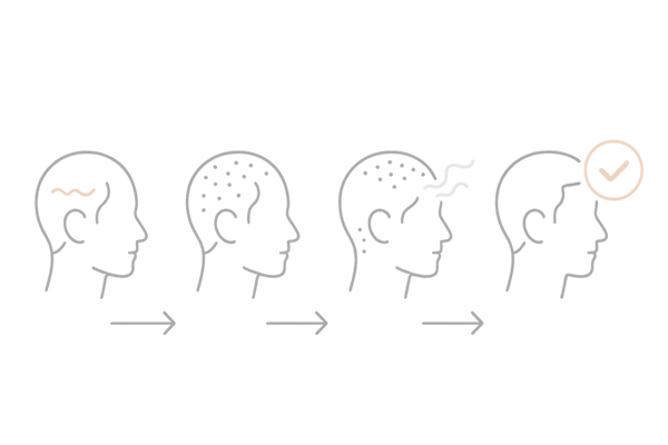 植毛手術後の痛みの経過(術後24時間〜1か月の流れ)