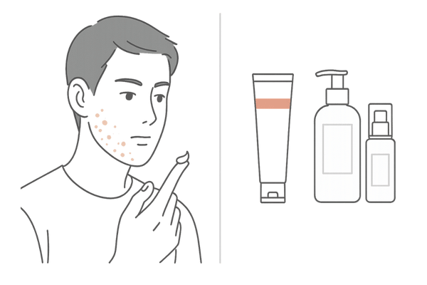 顎・フェイスラインの炎症ニキビをケトコナゾールでケアする男性のイメージ