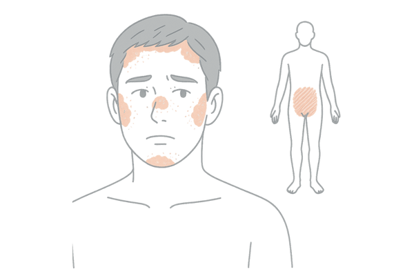 脂漏性皮膚炎の症状が出やすい部位を示す男性イラスト(頭皮・顔・陰部)