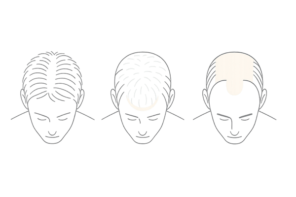 男性びまん性脱毛症とAGAの薄毛パターンの違いを示すイラスト