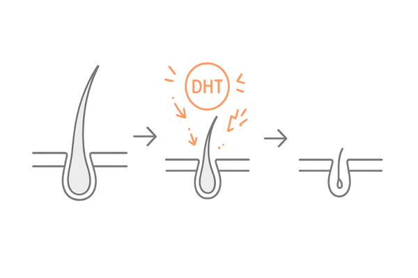 DHTによる生え際薄毛のメカニズム（毛包ミニチュア化の流れ）