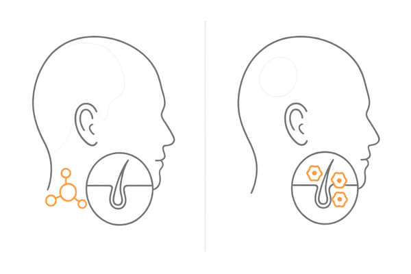 AGAと円形脱毛症の違い（原因・脱毛パターン）比較イメージ