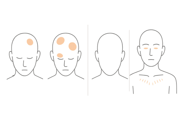 円形脱毛症のタイプ別症状イメージ図