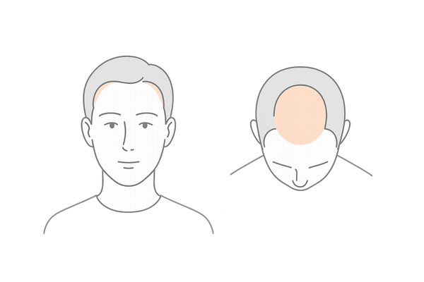 M字型脱毛と頭頂部型脱毛の違いを比較したイラスト｜ミノキシジル治療を検討する男性向け