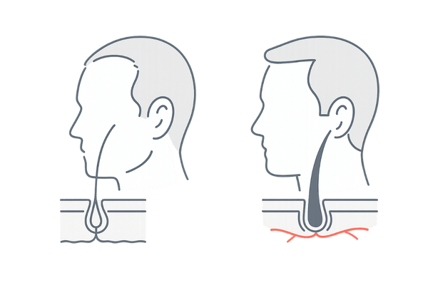 M字型脱毛部位に作用するミノキシジルの発毛メカニズム図解