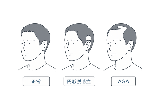 円形脱毛症とAGAの脱毛パターンの違いを比較したイラスト