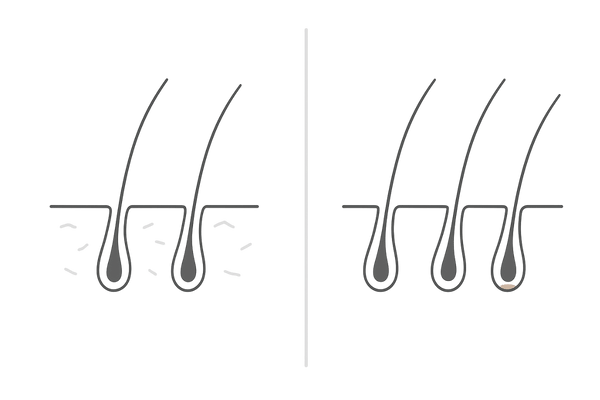 乾燥頭皮と皮脂過多によるヒリヒリ感の比較イメージ