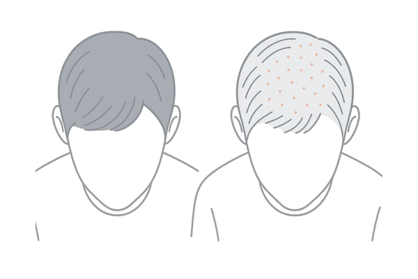 頭皮の地肌が見える原因を示すイメージ|正常な毛量と薄毛初期の比較図