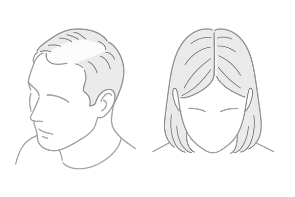 男性と女性で異なる薄毛パターン比較|生え際後退と分け目の広がり